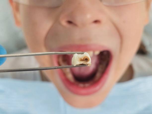Best Emergency Tooth Extraction in Leisure Knoll, NJ